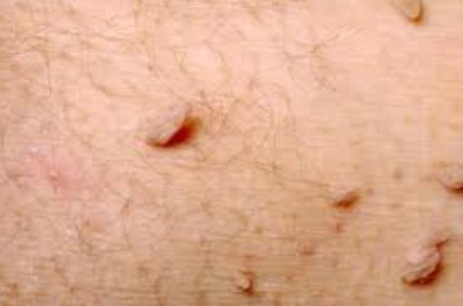 Image 1 from Services | Suntara | Minor Skin Surgery