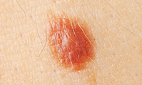 Image 2 from Services | Suntara | Minor Skin Surgery