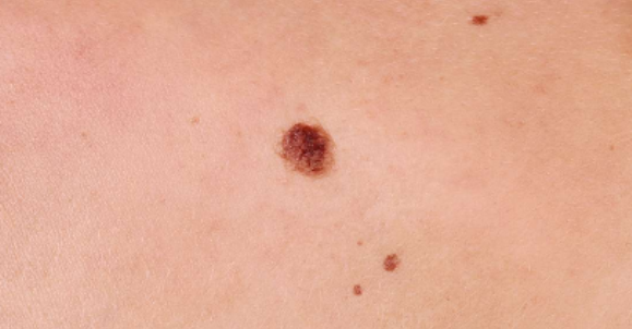 Image 3 from Services | Suntara | Minor Skin Surgery
