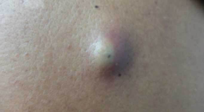 Image 4 from Services | Suntara | Minor Skin Surgery