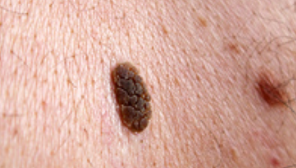 Image 5 from Services | Suntara | Minor Skin Surgery