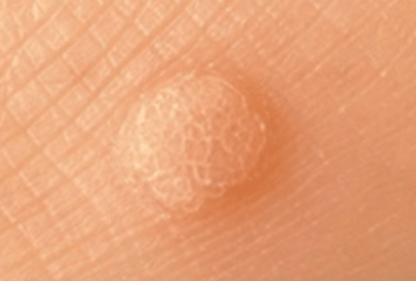 Image 6 from Services | Suntara | Minor Skin Surgery