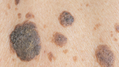 Image 7 from Services | Suntara | Minor Skin Surgery