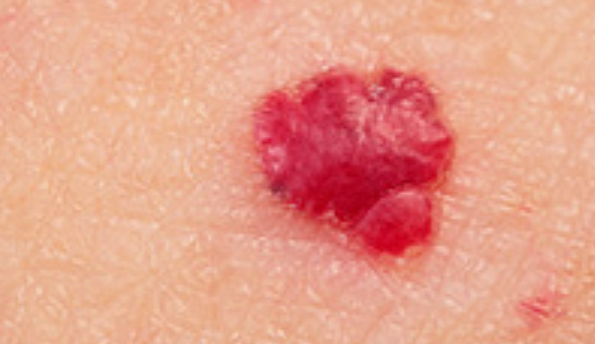 Image 8 from Services | Suntara | Minor Skin Surgery